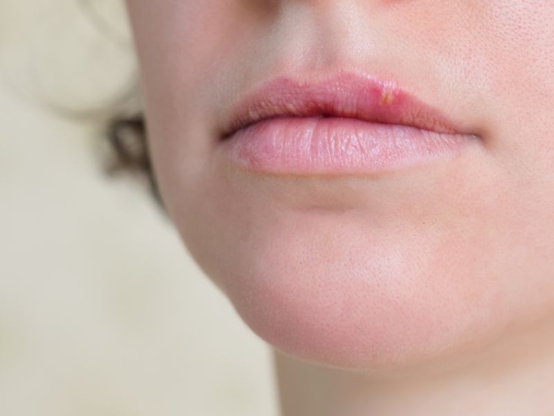 Lippenherpes (Herpes simplex)