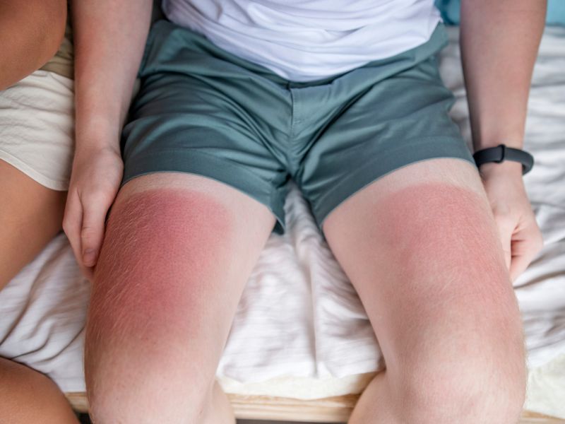 Sonnenbrand homöopathisch behandeln