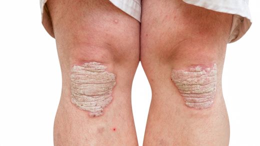 Schuppenflechte (Psoriasis) • Ursache, Symptome & Behandlung