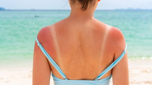 What to do if you get sunburned? These home remedies help