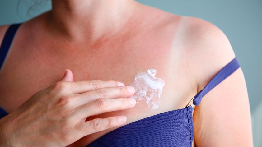 Sonnenbrand: Was hilft gegen Juckreiz und Schmerzen?