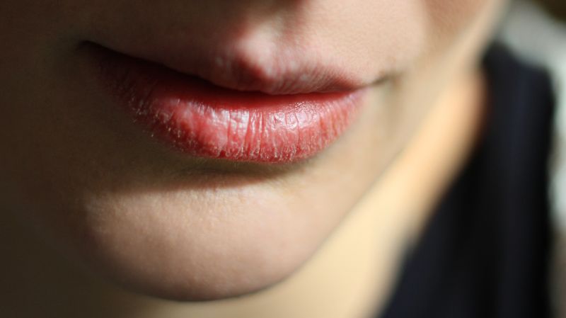 Ausschlag Um den Mund & Was verursacht einen Lippenausschlag
